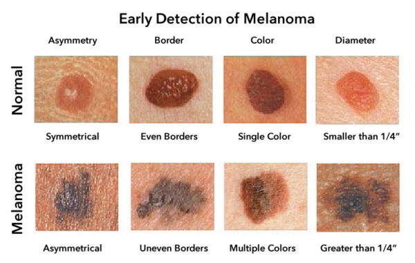 Types of skin cancer | Understanding the Three Main Types of Skin Canc