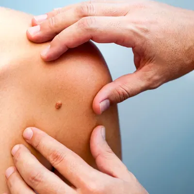 Mole on shoulder Mole on shoulder